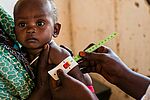 Kind Unterernährung beim Arzt, Hunger